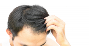 Hair Replacement Singapore
