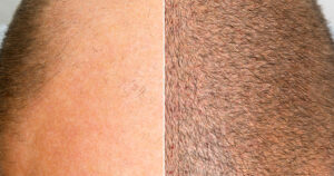 Hair Replacement vs Hair Transplant: 5 Key Differences