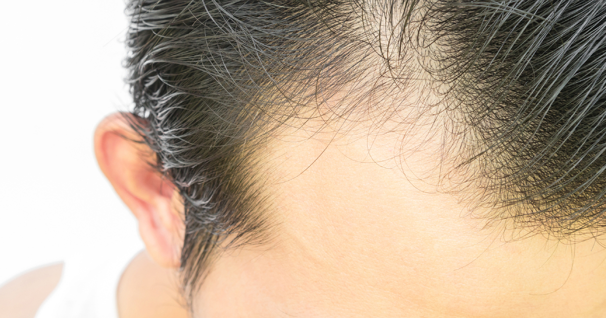 Hair Replacement Systems vs Cheaper Options: Is It Worth It?