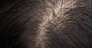 Best Hair Replacement Systems for Men with Thinning Crowns