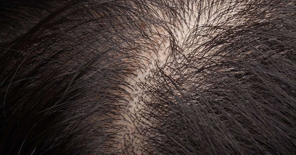 Best Hair Replacement Systems for Men with Thinning Crowns