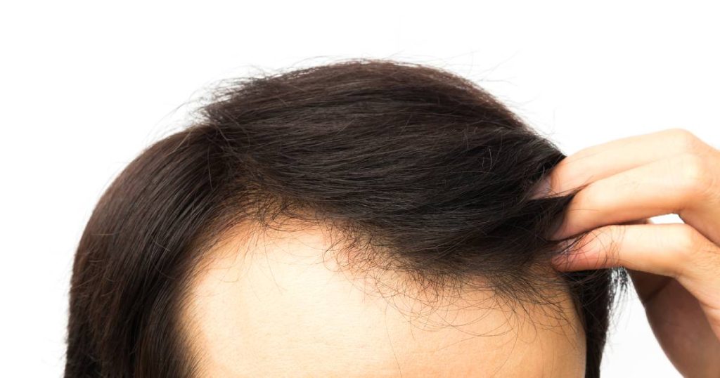 Full Monthly Cost Breakdown of Wearing a Hair System in SG